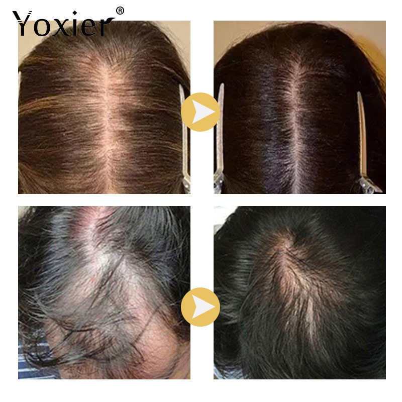 Intensive Growth Serum Prevent - Hair Care Growth review and price