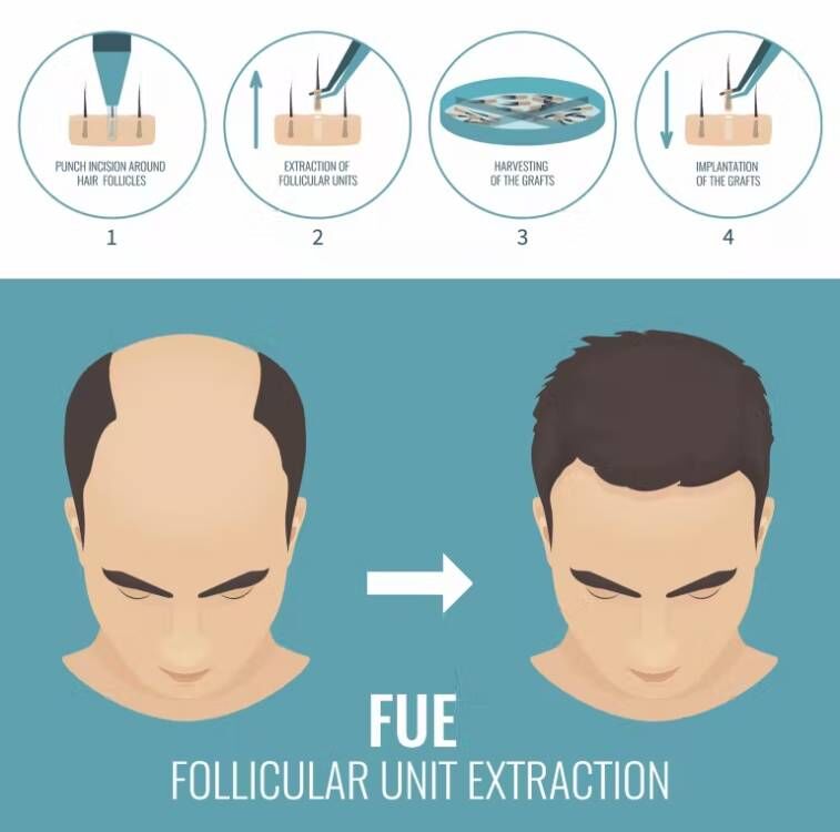 FUE Hair Implant Micro Motor H - Hair Care Basic review and price